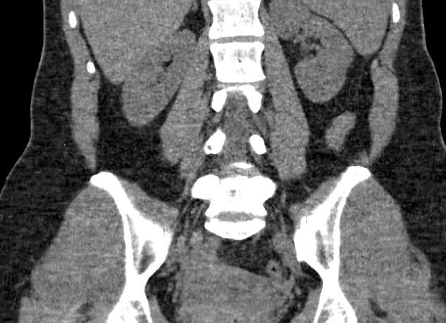 Мрт почек мочеточников