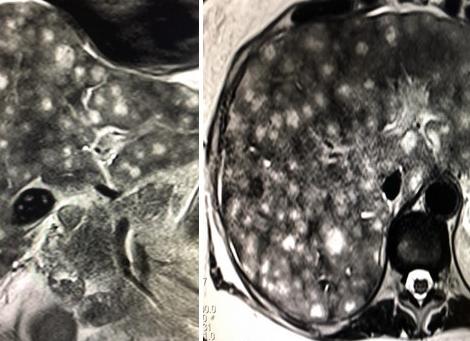 Мрт печени с контрастом что показывает