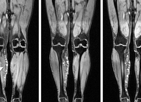 Мрт мягких тканей голени