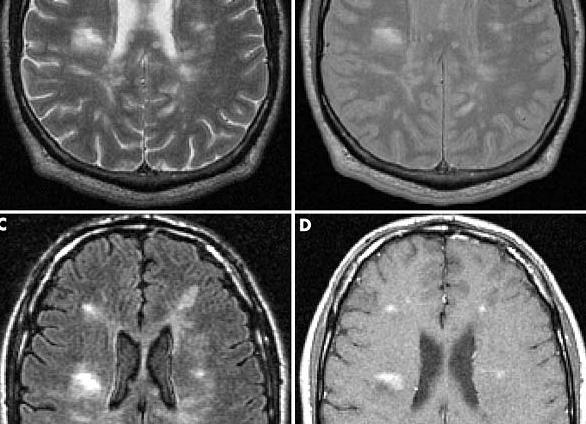 Можно ли по мрт определить рассеянный склероз