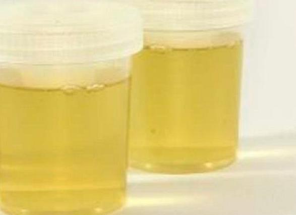 Моча лимонного цвета причины