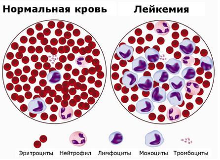 Кровь при лейкозе