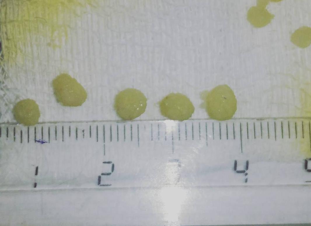 Как выглядит песок в моче Как выглядит песок в моче