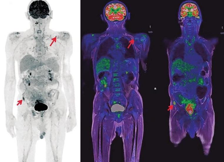 Что такое пэт в онкологии
