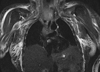 Что показывает мрт средостения