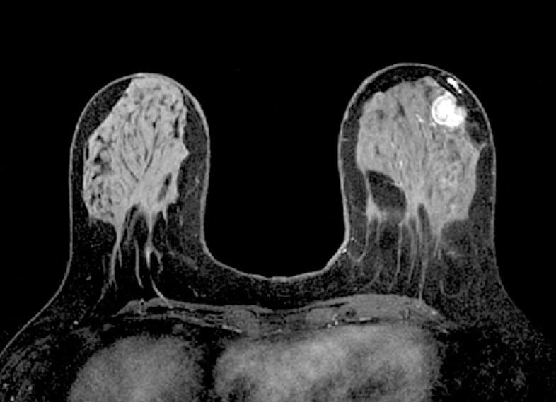 Что показывает мрт молочных желез с контрастом