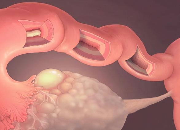 Аднексит хронический что это такое