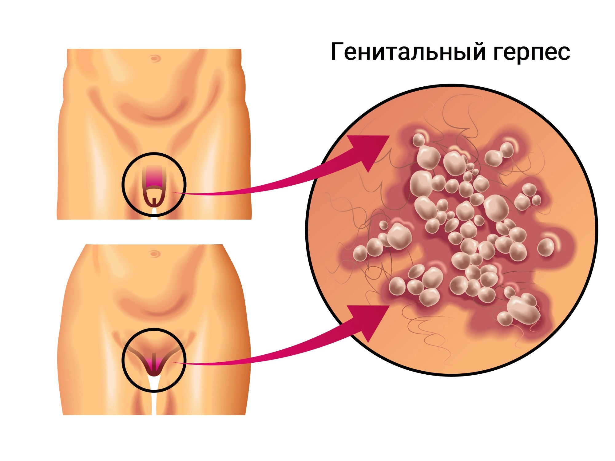 Генитальный герпес это
