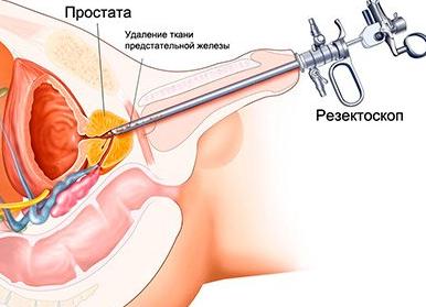 Кровь в моче у мужчины с болью