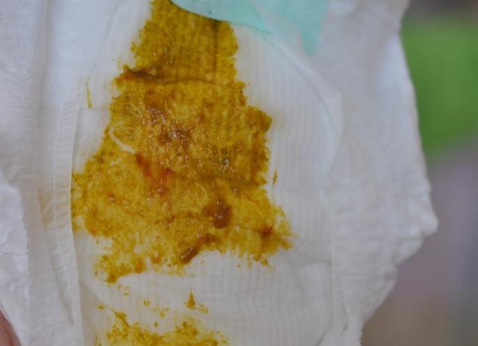 Красные прожилки в кале у грудничка Красные прожилки в кале у грудничка