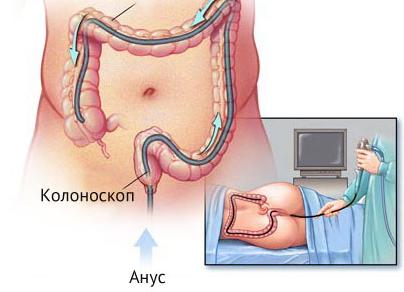 Кольпоскопия прямой кишки что это такое