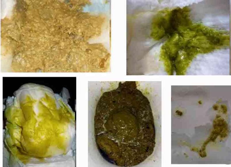 Кал при сальмонеллезе