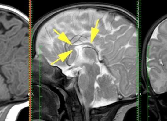 Гипогенезия мозолистого тела