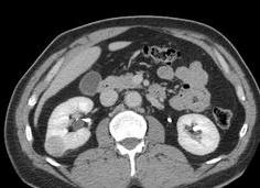 Гиперваскулярное образование почки что это такое Гиперваскулярное образование почки что это такое