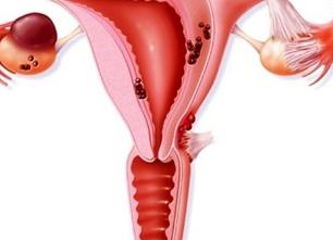 Генитальный наружный эндометриоз