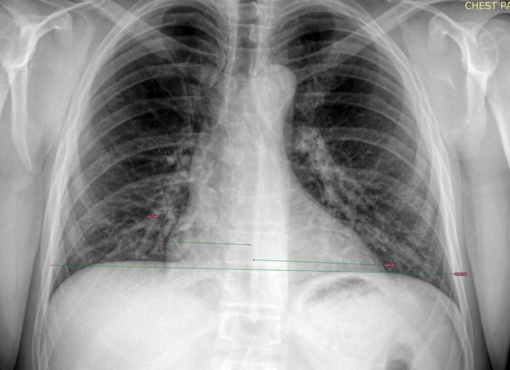 Флюорография сердца с контрастированием пищевода