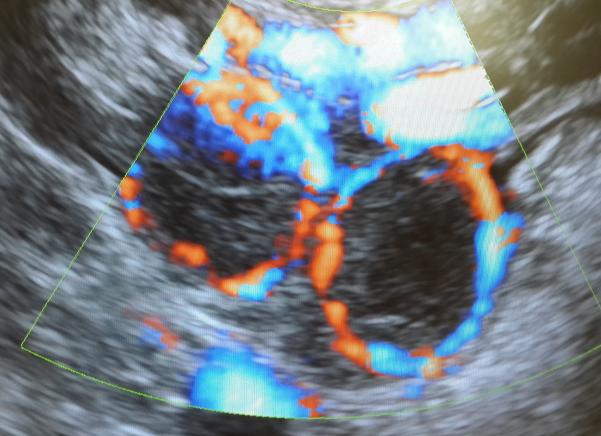 Два желтых тела в одном яичнике