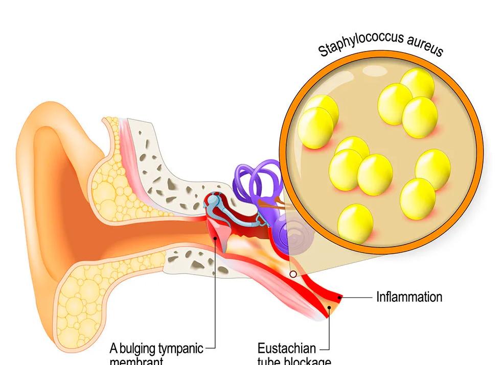 Что такое стафилококк у взрослых и откуда он берется