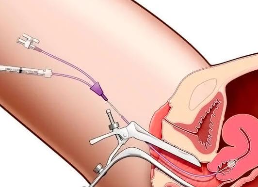 Что такое пайпель биопсия