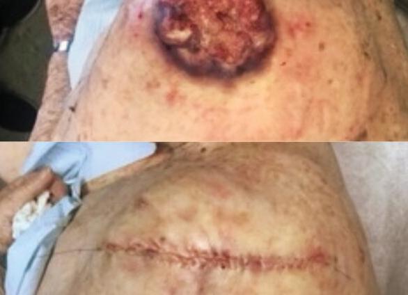 Болезнь рак фото в организме