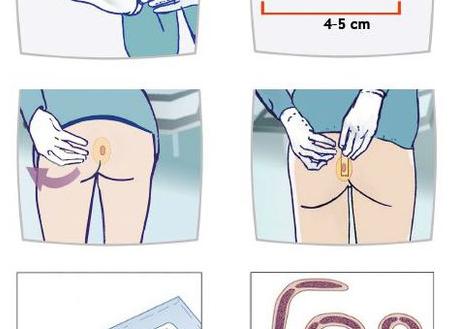 Анализ на энтеробиоз что это такое как сдавать