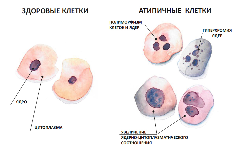 Гиперплазия эндоцервикса что это такое