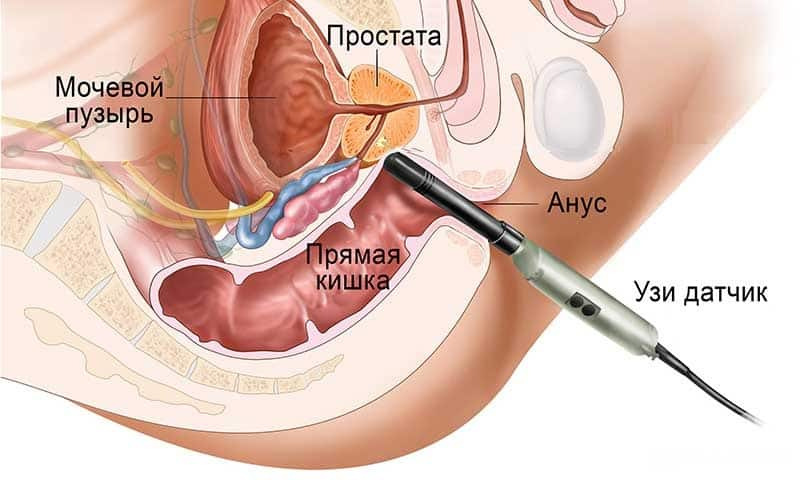 Как проводят узи простаты