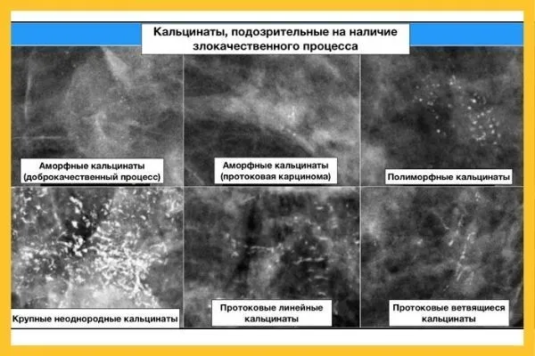 Кальцинаты в молочной железе что это такое