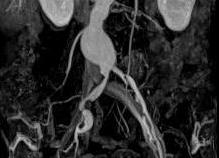 Мрт сосудов брюшной полости