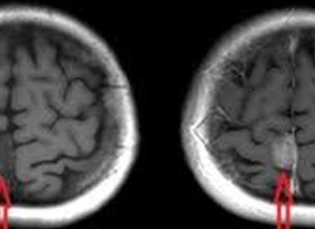 Мрт с контрастированием головного мозга что это такое