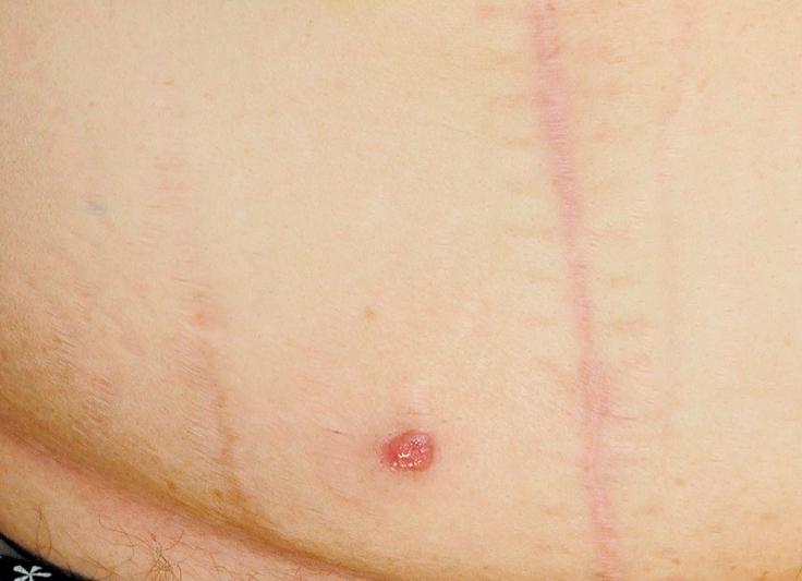 Метастазы на коже фото