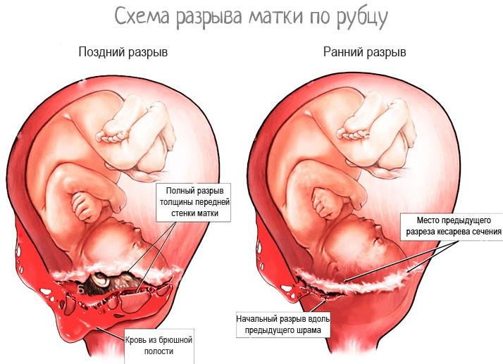 Матка после кесарева
