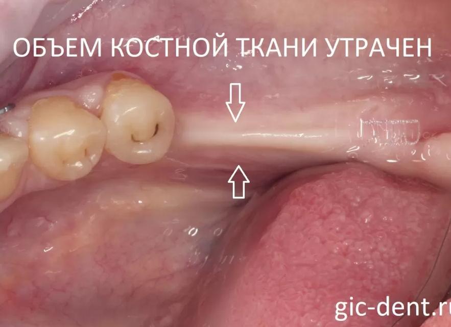 Костная ткань что такое