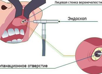 Киста верхней челюстной пазухи