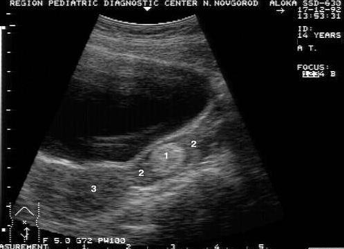 Гиперэхогенное включение в яичнике