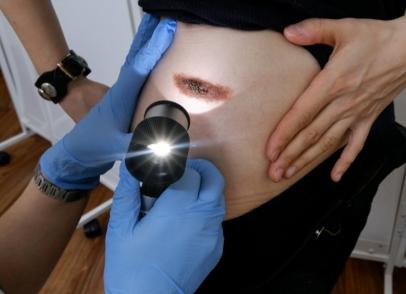 Что делать сорвала родинку