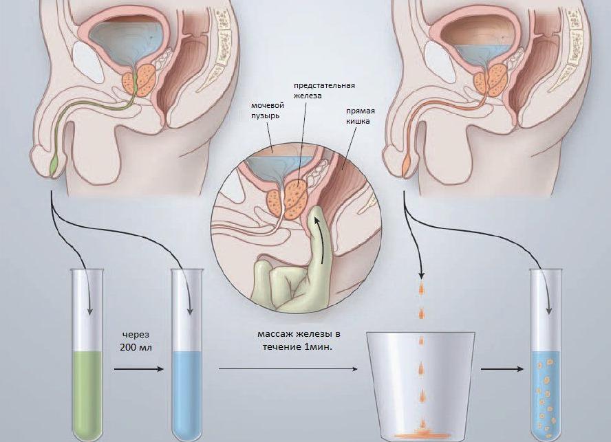 Бак посев у мужчин