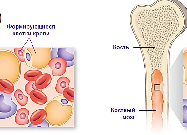 Апластическая анемия идиопатическая