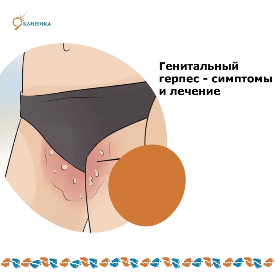 Генитальный герпес что это
