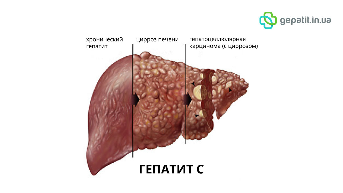 Гепатит с генотип 1 что это значит