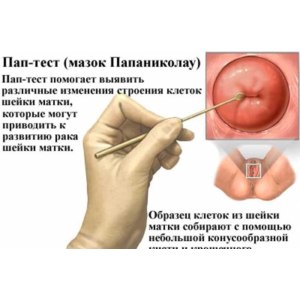 Мазок на ак что это такое
