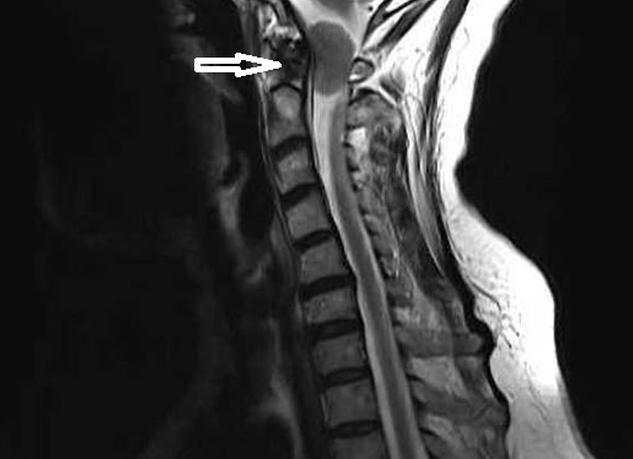 Мрт краниовертебрального перехода что это