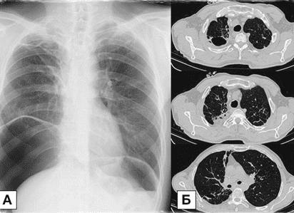 Кт легких снимок