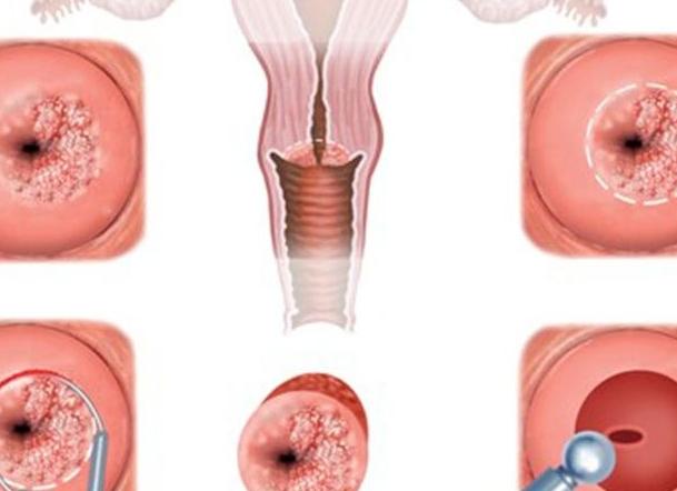 Кровоточит эрозия шейки матки что делать