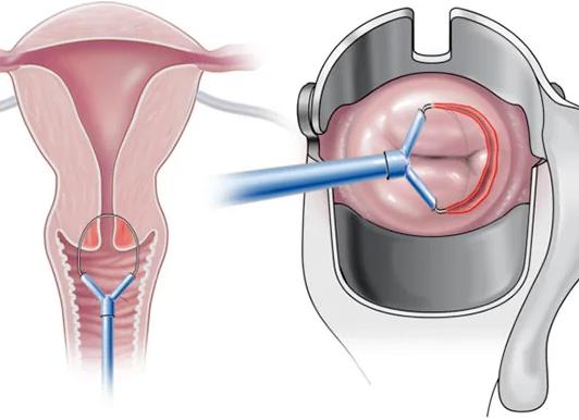 Кольпоскопия и мазок на онкоцитологию