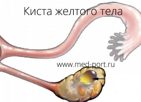 Кистозное желтое тело в левом яичнике