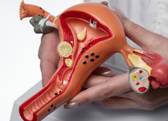 Киста на шейке Киста на шейке