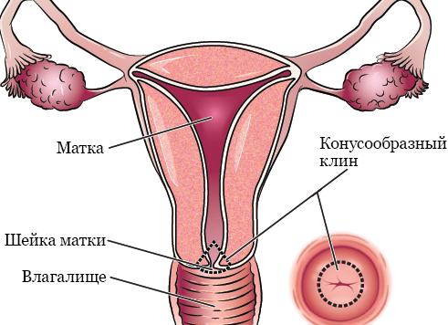 Как берут анализ на биопсию шейки матки