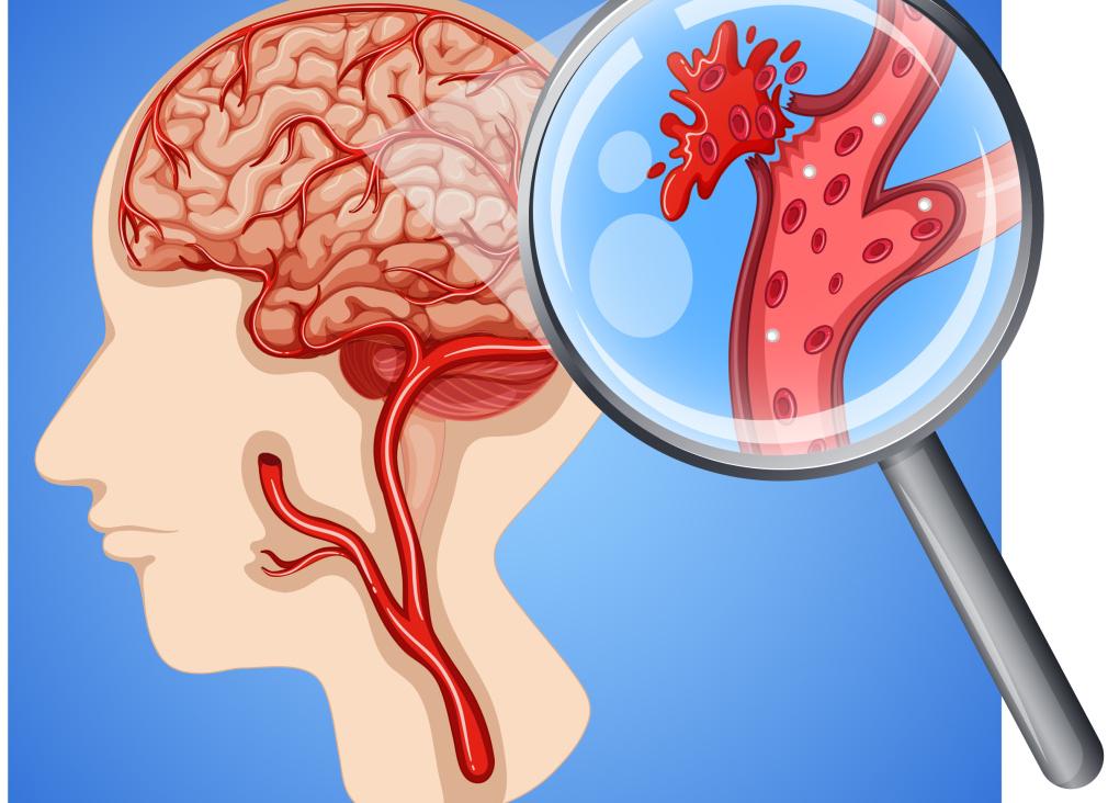 Ишемия головного мозга что за болезнь