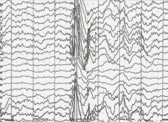 Ээг при эпилепсии